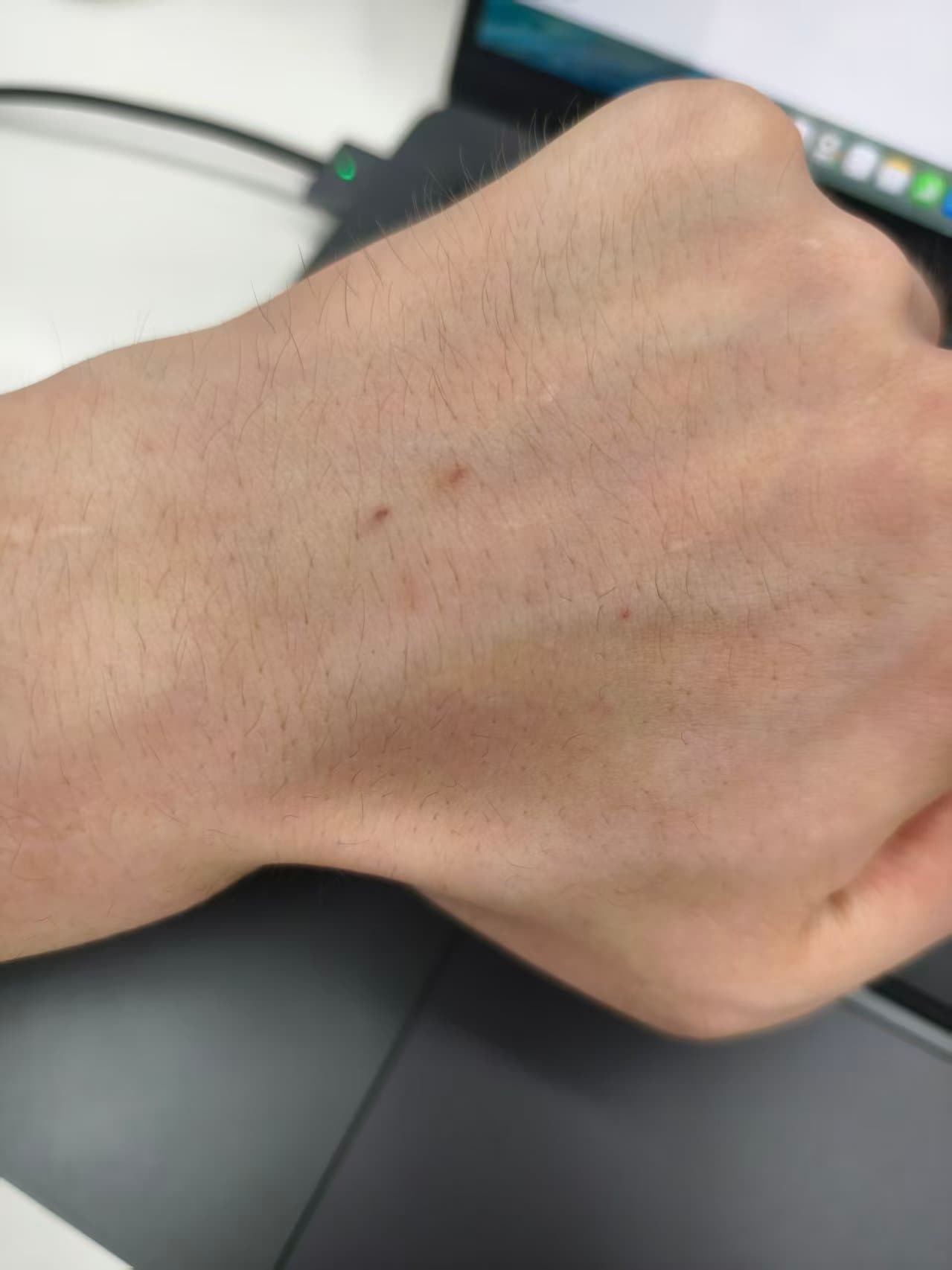 输液之后手背上留下的针眼和淤青。